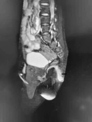 Anal Canal Duplication Mimicking Recurrent Abscess: A Case Report and Review of the Literature